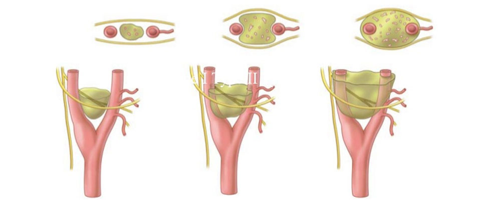 Carotid body tumors