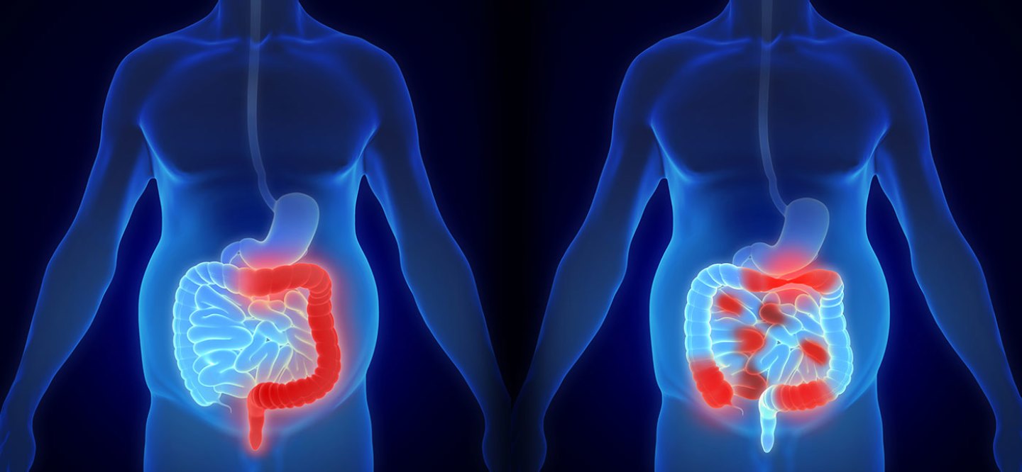 colorectal cancer surgeon in delhi