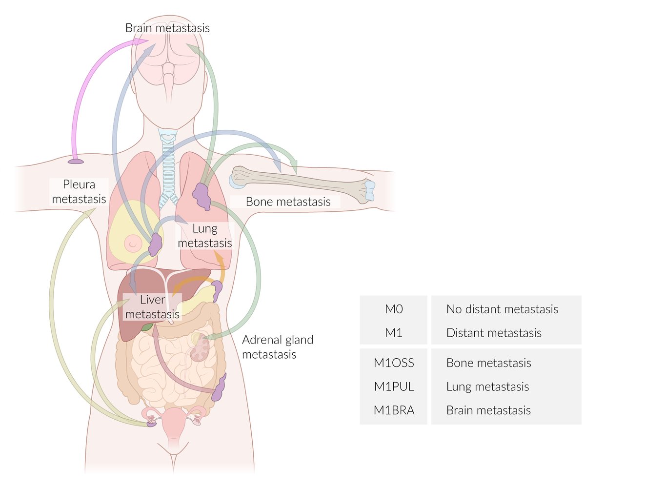 METASTASIS OF UNKNOWN ORIGIN