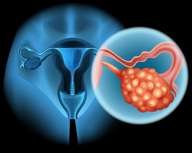 gynecological cancee treatment