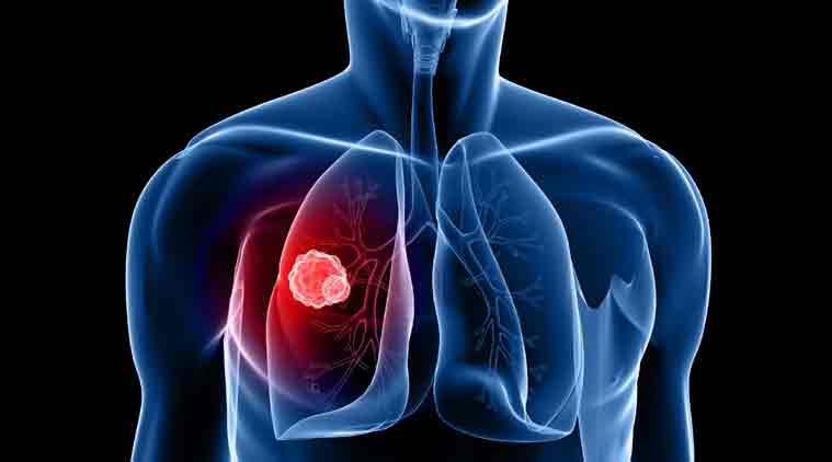 lung cancer specialist in dwarka