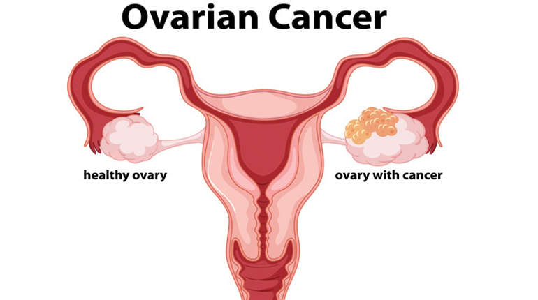 ovarian cancer specialist in delhi