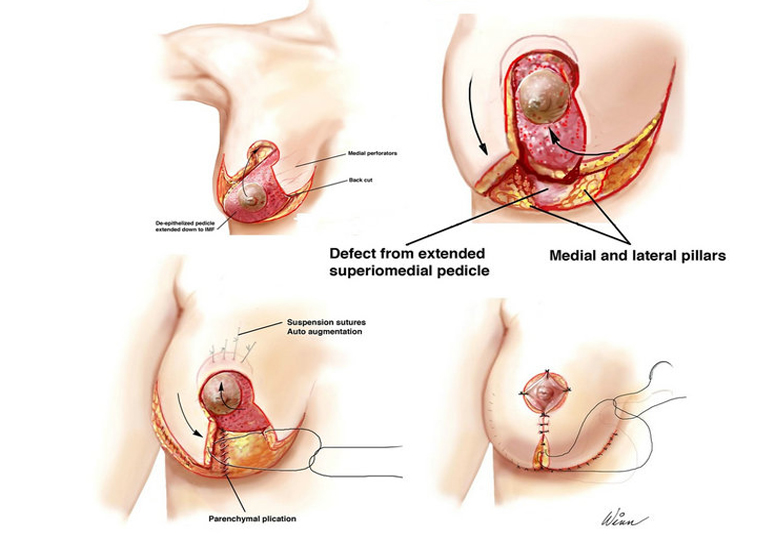 Breast Conservative Surgery in Delhi