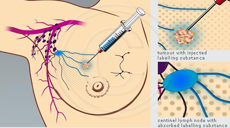 Sentinel Node Biopsy Surgeon in Delhi